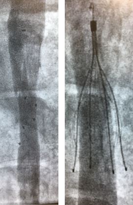 Fluoroscopic images of the absorbable (left) and control metal IVC filter (right)